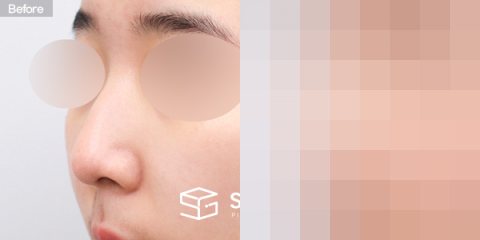 슈가성형외과 첫) 코끝 + 매부리코 + 무보형물 코성형 + 절골 + 귀연골 전후사진 - 정면 수술 전후 비교