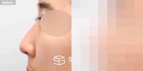 슈가성형외과 첫) 코끝 + 매부리코 + 무보형물 코성형 + 절골 + 귀연골 전후사진 - 45도 수술 전후 비교