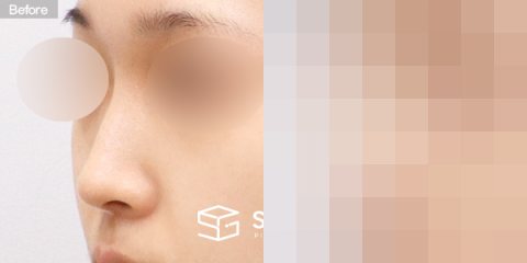슈가성형외과 첫) 콧대 + 코끝 + 매부리코 + 비중격 전후사진 - 정면 수술 전후 비교