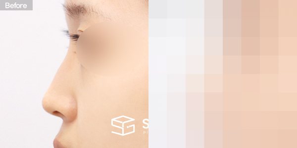 슈가성형외과 첫) 콧대 + 코끝 + 매부리코 + 비중격 전후사진 - 45도 수술 전후 비교