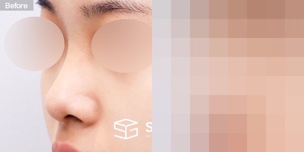 슈가성형외과 첫) 콧대 + 코끝 + 귀연골 전후사진 - 정면 수술 전후 비교