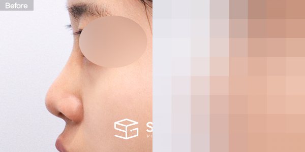슈가성형외과 첫) 콧대 + 코끝 + 귀연골 전후사진 - 45도 수술 전후 비교