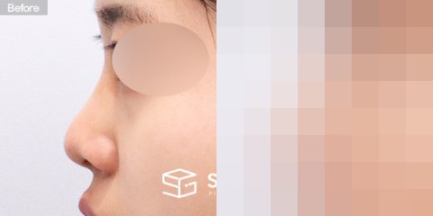 슈가성형외과 첫) 콧대 + 코끝 + 귀연골 전후사진 - 45도 수술 전후 비교
