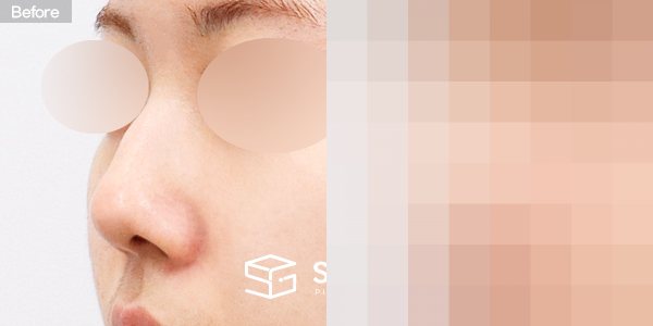 슈가성형외과 첫) 콧대 + 코끝 + 매부리코 + 절골 + 비중격 + 귀연골 전후사진 - 정면 수술 전후 비교