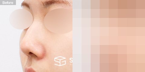 슈가성형외과 첫) 콧대 + 코끝 + 매부리코 + 절골 + 비중격 + 귀연골 전후사진 - 정면 수술 전후 비교