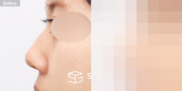 슈가성형외과 첫) 콧대 + 코끝 + 매부리코 + 절골 + 비중격 + 귀연골 전후사진 - 45도 수술 전후 비교