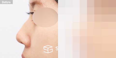 슈가성형외과 첫) 콧대 + 코끝 + 매부리코 + 절골 + 비중격 + 귀연골 전후사진 - 45도 수술 전후 비교