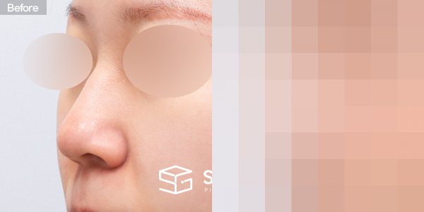 슈가성형외과 첫) 콧대 + 코끝 + 매부리코 + 복코 + 콧볼 축소 + 귀연골 전후사진 - 정면 수술 전후 비교