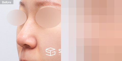 슈가성형외과 첫) 콧대 + 코끝 + 매부리코 + 복코 + 콧볼 축소 + 귀연골 전후사진 - 정면 수술 전후 비교