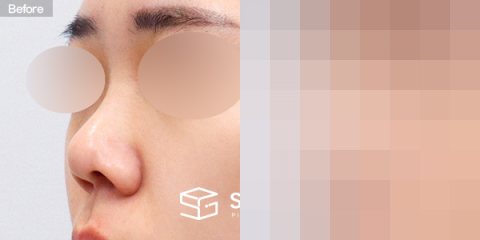 슈가성형외과 첫) 콧대 + 코끝 + 복코 + 콧볼 축소 + 비주 연장 + 비중격 + 자가늑 전후사진 - 정면 수술 전후 비교