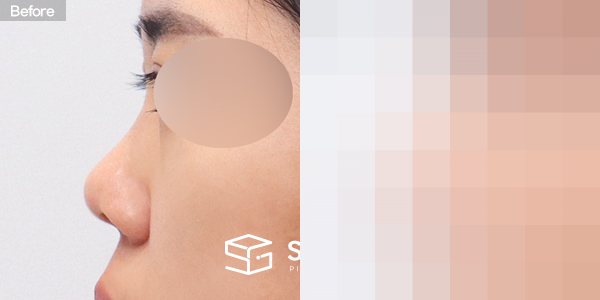 슈가성형외과 첫) 콧대 + 코끝 + 복코 + 콧볼 축소 + 비주 연장 + 비중격 + 자가늑 전후사진 - 45도 수술 전후 비교