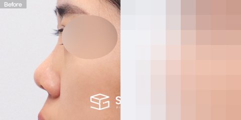 슈가성형외과 첫) 콧대 + 코끝 + 복코 + 콧볼 축소 + 비주 연장 + 비중격 + 자가늑 전후사진 - 45도 수술 전후 비교