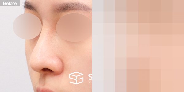 슈가성형외과 재) 재수술 + 매부리코 + 휜코 + 비공 내리기 + 비중격 전후사진 - 정면 수술 전후 비교