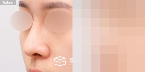 슈가성형외과 재) 재수술 + 매부리코 + 휜코 + 비공 내리기 + 비중격 전후사진 - 정면 수술 전후 비교
