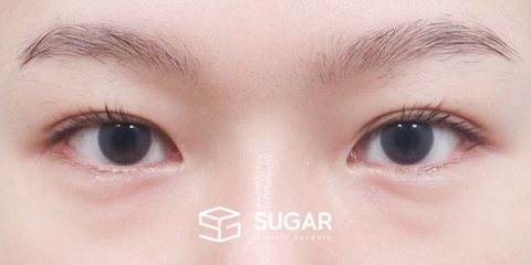 슈가성형외과 첫) 자연유착 + 눈매교정 + 윗트임 + 뒤밑트임 + 눈 밑 지방재배치 전후사진 - 수술 전