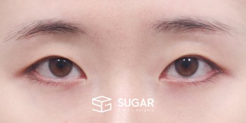슈가성형외과 첫) 자연유착 + 눈매교정 + 뒤밑트임 전후사진 - 수술 전