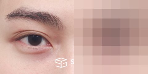 슈가성형외과 첫) 절개(라인 낮추기) + 눈매교정 + 눈 위 지방이식 전후사진 - 정면 수술 전후 비교