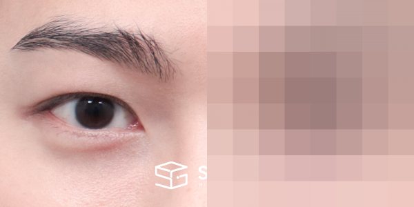 슈가성형외과 첫) 절개(라인 낮추기) + 눈매교정 + 눈 위 지방이식 전후사진 - 45도 수술 전후 비교