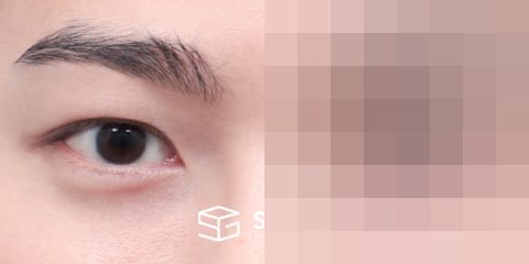 슈가성형외과 첫) 절개(라인 낮추기) + 눈매교정 + 눈 위 지방이식 전후사진 - 45도 수술 전후 비교