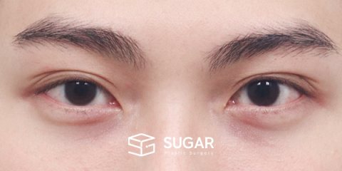 슈가성형외과 첫) 절개(라인 낮추기) + 눈매교정 + 눈 위 지방이식 전후사진 - 수술 전