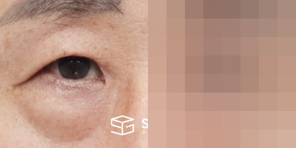 슈가성형외과 첫) 눈썹 거상 + 중안면부 거상 + 하안검 + 자연유착 + 뒤밑트임 + 눈 밑 지방 제거 전후사진 - 정면 수술 전후 비교