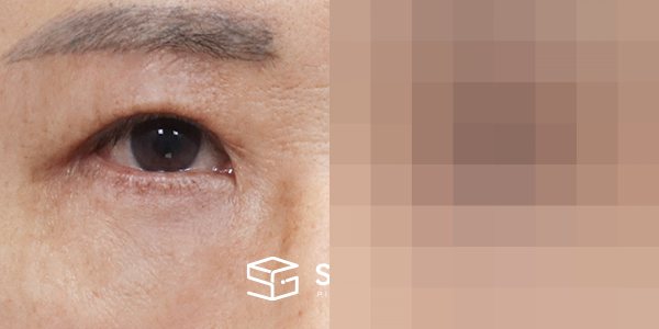슈가성형외과 첫) 눈썹 거상 + 중안면부 거상 + 하안검 + 자연유착 + 뒤밑트임 + 눈 밑 지방 제거 전후사진 - 45도 수술 전후 비교