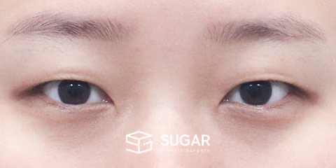 슈가성형외과 첫) 자연유착 + 눈매교정 + 뒤밑트임 전후사진 - 수술 전