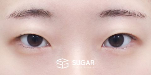 슈가성형외과 첫) 자연유착 + 눈매교정 + 윗트임 전후사진 - 수술 전