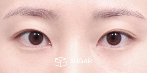슈가성형외과 첫) 자연유착 전후사진 - 수술 전