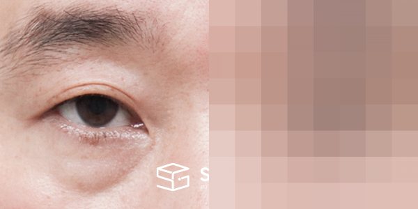 슈가성형외과 첫) 눈썹 거상 + 자연유착 + 눈 밑 지방 재배치 + 뒤밑트임 전후사진 - 정면 수술 전후 비교