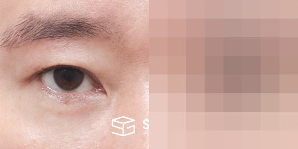 슈가성형외과 첫) 눈썹 거상 + 자연유착 + 눈 밑 지방 재배치 + 뒤밑트임 전후사진 - 45도 수술 전후 비교