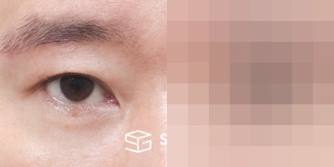 슈가성형외과 첫) 눈썹 거상 + 자연유착 + 눈 밑 지방 재배치 + 뒤밑트임 전후사진 - 45도 수술 전후 비교
