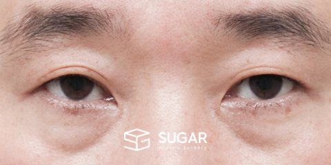 슈가성형외과 첫) 눈썹 거상 + 자연유착 + 눈 밑 지방 재배치 + 뒤밑트임 전후사진 - 수술 전