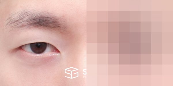 슈가성형외과 첫) 자연유착 + 눈매교정 전후사진 - 정면 수술 전후 비교