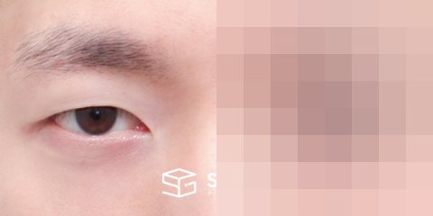 슈가성형외과 첫) 자연유착 + 눈매교정 전후사진 - 정면 수술 전후 비교