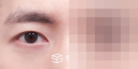 슈가성형외과 첫) 자연유착 + 눈매교정 전후사진 - 45도 수술 전후 비교