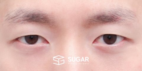 슈가성형외과 첫) 자연유착 + 눈매교정 전후사진 - 수술 전