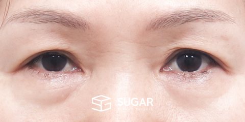 슈가성형외과 첫) 눈썹 거상 + 중안면부 거상 + 절개 + 하안검 전후사진 - 수술 전