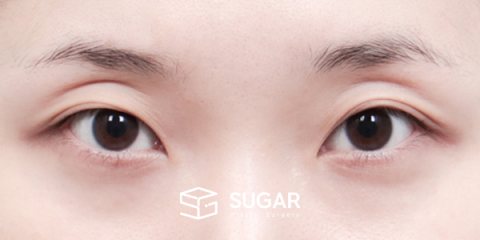슈가성형외과 재) 자연유착 + 눈매교정 + 윗트임 + 뒤밑트임 + 재수술 전후사진 - 수술 전