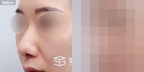 슈가성형외과 첫) 무보형물+복코+비중격연장+만곡증교정+귀연골+비중격+귀근막 전후사진 - 정면 수술 전후 비교