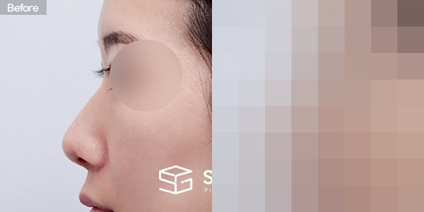 슈가성형외과 첫) 무보형물+복코+비중격연장+만곡증교정+귀연골+비중격+귀근막 전후사진 - 45도 수술 전후 비교