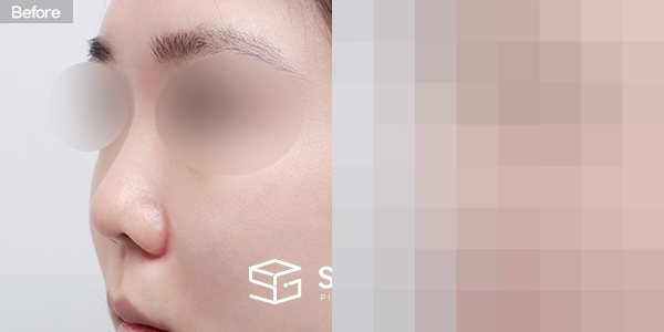 슈가성형외과 첫) 콧대+코끝+짧은코+복코+기증늑+귀연골 전후사진 - 정면 수술 전후 비교