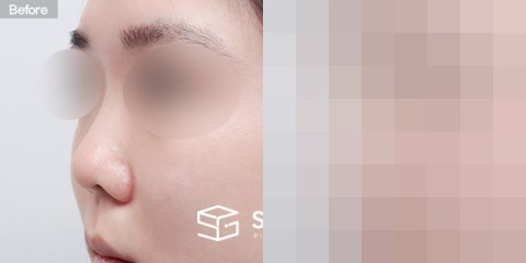 슈가성형외과 첫) 콧대+코끝+짧은코+복코+기증늑+귀연골 전후사진 - 정면 수술 전후 비교