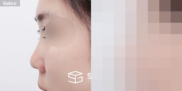 슈가성형외과 첫) 콧대+코끝+짧은코+복코+기증늑+귀연골 전후사진 - 45도 수술 전후 비교