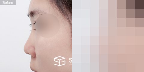 슈가성형외과 첫) 콧대+코끝+짧은코+복코+기증늑+귀연골 전후사진 - 45도 수술 전후 비교