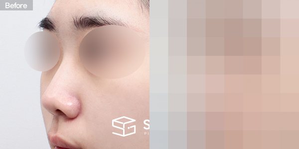 슈가성형외과 첫) 콧대+비중격연장+짧은코+코선반교정+귀연골 전후사진 - 정면 수술 전후 비교
