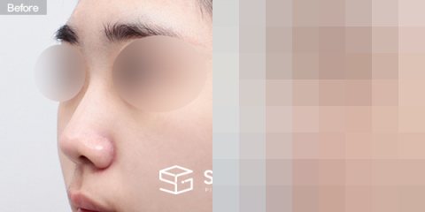 슈가성형외과 첫) 콧대+비중격연장+짧은코+코선반교정+귀연골 전후사진 - 정면 수술 전후 비교