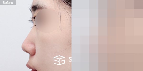 슈가성형외과 첫) 콧대+비중격연장+짧은코+코선반교정+귀연골 전후사진 - 45도 수술 전후 비교