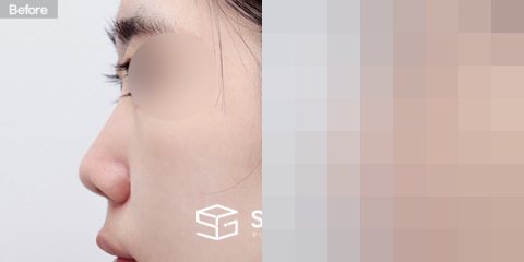 슈가성형외과 첫) 콧대+비중격연장+짧은코+코선반교정+귀연골 전후사진 - 45도 수술 전후 비교