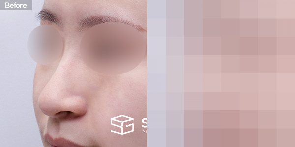 슈가성형외과 첫) 코끝+매부리코+휜코+복코+절골+비중격 전후사진 - 정면 수술 전후 비교